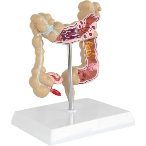 Anatomical Human Colorectal Lesion Model Anatomy Colon Diseases Intestine Medical Teaching Learning Supplies Tool