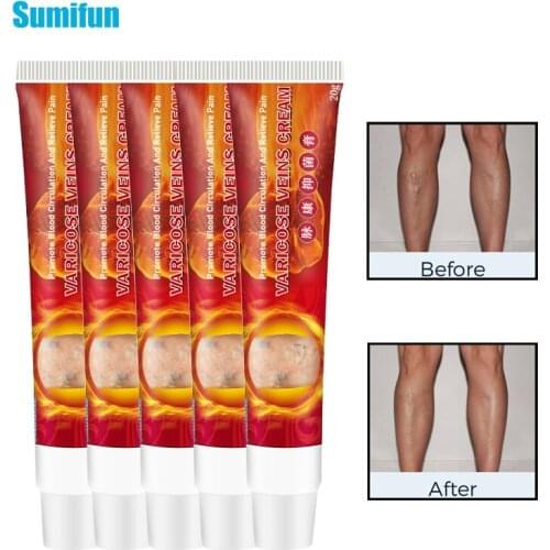 5pcs Sumifun Varicose Veins Ointment Varicosity Angiitis Remedy Treatment Plaster Pain Relief For Varicose Veins Of Legs D3176