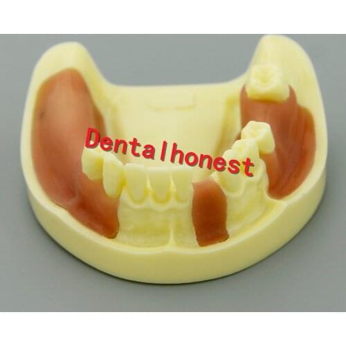 NEW Dental Lower Jaw Implant Practice Typodont Teeth Model with Gingiva
