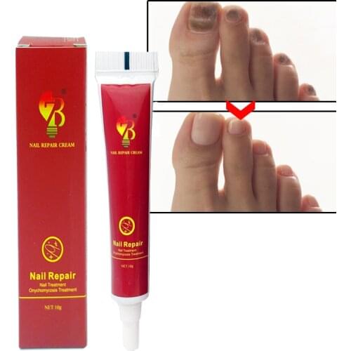 Best Chinese Medicine Herbs Nail Treatment Cream Paronychia Anti Nail Infection Fights Bacteria And Naturally