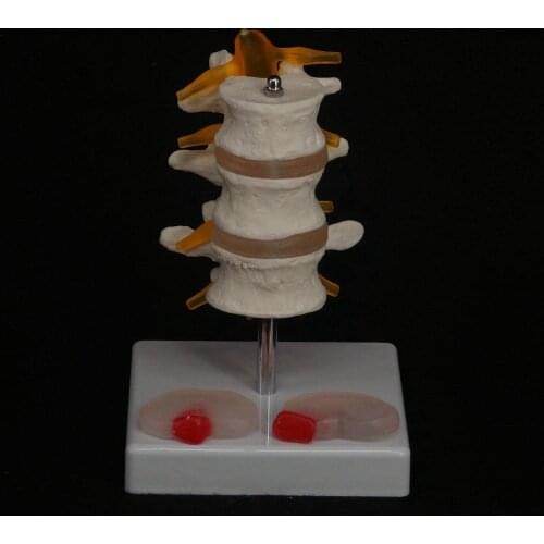 Human Three Lumbar Lesions Intervertebral Disc Skeleton Spine Medical Model