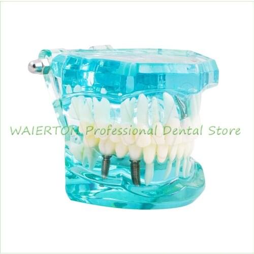 Dental Study Tooth Model Adult Pathological teaching Teeth model new denshine