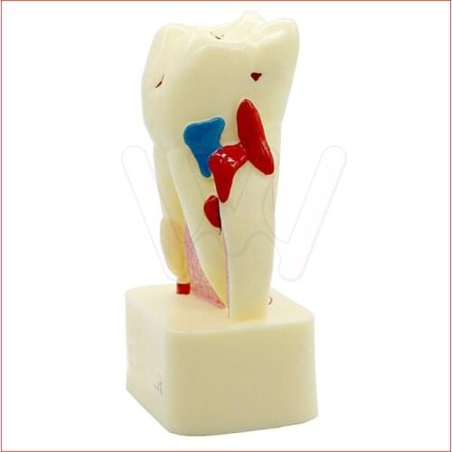 Tooth model dental pathology teeth model, dental caries, calculus, pulp stones, Occlusal tooth wear
