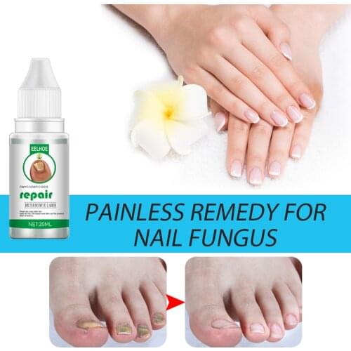 20ML Nail Fungus Treatment Feet Care Essence Fungal Nail Foot Toe Repair Removal Gel Anti Infection Paronychia Onychomycosi