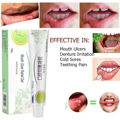 Mouth Ulcer Relief Gel Natural Herbal Oral Antibacterial Cream Fast Relief from Severe Pain & Irritation within 2 minutes