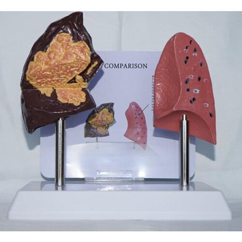 Smoking Lung and Normal Lung Comparison Organ Model-pathological Lung Anatomy Model- for Study Teaching Medical Model
