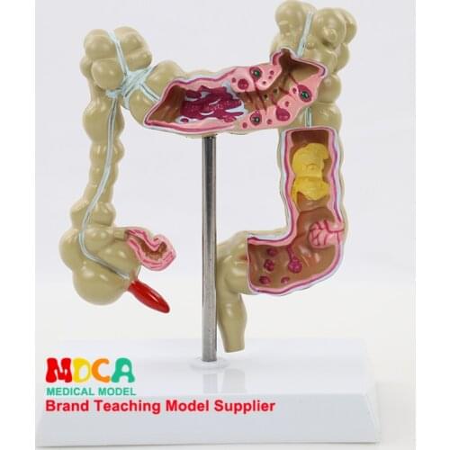 MCW005 Teaching of Colorectal Model Medicine in Human Colon Pathological Lesion Model