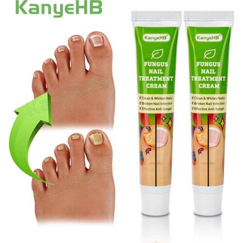 2pcs Nail Fungal Treatment Feet Care Ointment Nail Foot Whitening Toe Nail Fungus Removal Cream Paronychia Onychomycosis A652