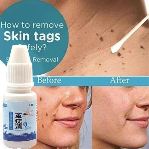 10ml Wart Treatment Papillomas Removal Of Warts Liquid Verruca From Remedy Moles Band-Aid Skin Remover Anti Removing Agains X4Z0