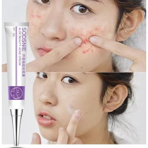 SODSNIE Aloe Natural Cream Treatment Acne Cream Anti Acne Repair Facial Skin Moisturizing Cream Natural Herbal Scar Removal Gel