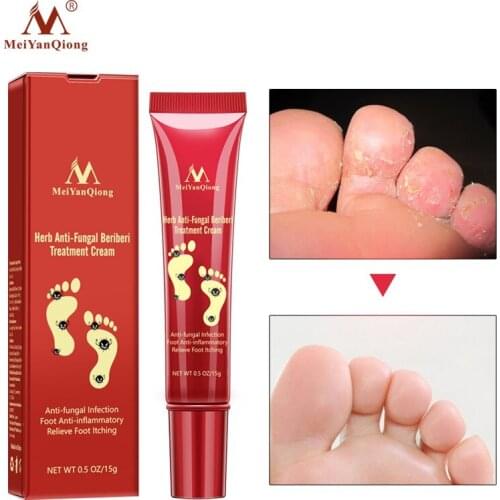 15g Nail Care Herbal Nail Repair Cream Anti Fungal Nail Chinese Herbal Toe Nail Fungus Treatment