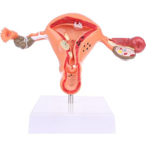 Human Women Female Uterus Ovary Pathology Model athological Uterus Ovary Anatomical Model Anatomy Medical Teaching Supplies