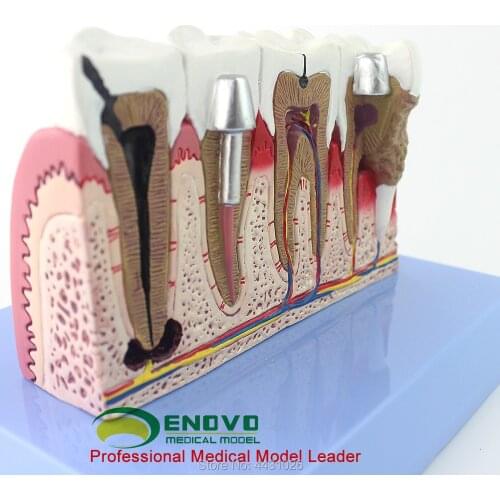 ENOVO Dental model of dental dental disease