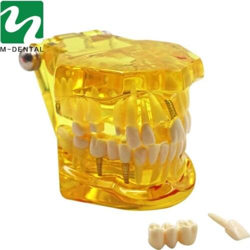 1PC Yellow Dental Implant Disease Teeth Model with Restoration Bridge Tooth Dentist for Teaching Adult Pathological Teeth Model