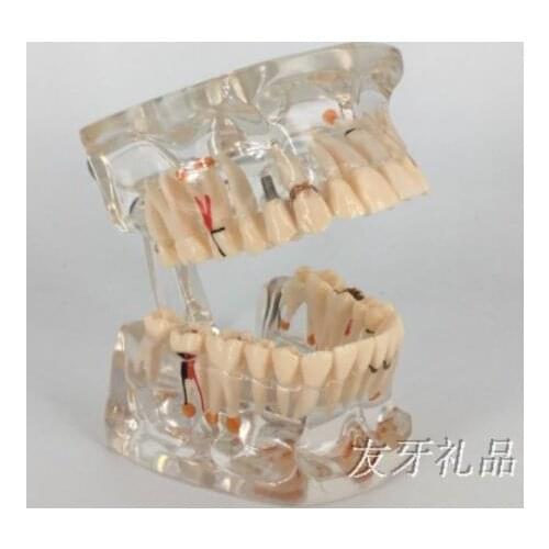 Adult transparent pathological small planting model Tooth model free shopping