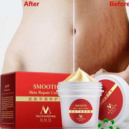 Maternity Skin Repair Body Cream For Stretch Marks Scar Removal Remove Scar Care Postpartum Regnancy Serum Smooth Skin Cream 80g