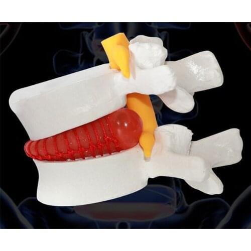 1.5X Human Anatomy Skeleton Spine Lumbar Disc Herniation Teaching Model Spine Lumbar Degenerative Model