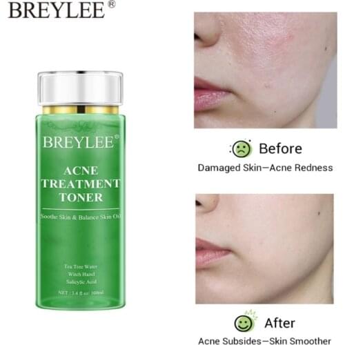 BREYLEE Acne Treatment Toner Oil Control Moisturizing Pimple Removal Shrink Pores Soothing Acne Whiten Tea Tree Face Serum 100ml