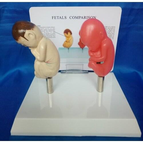 Fetals Comparison set smoking Fetal and Normal Fetals Model Human Body educational model