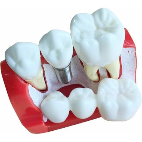 Implant Analysis Model Dental Teeth Model Dentistry Products for Teaching and Studying