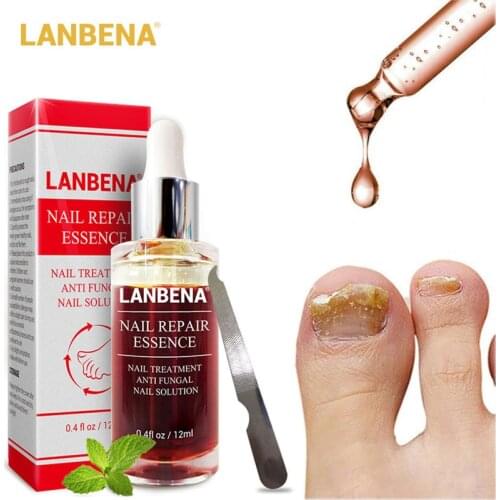 LANBENA Fungal Nail Repair Serum Essence Anti Infection Paronychia Onychomycosis Treatment Care Foot Nail Fungus Removal Gel