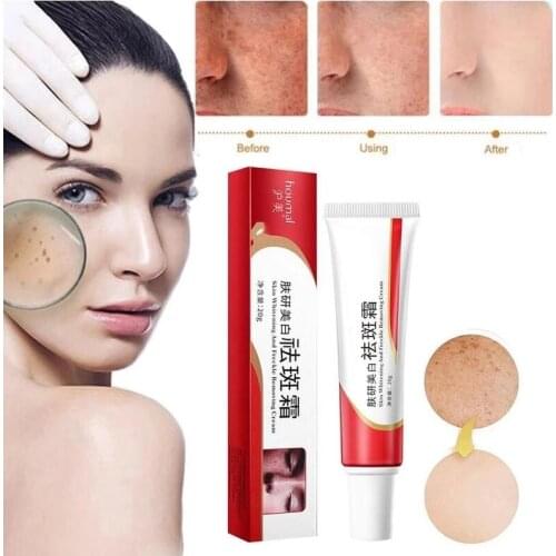 Whitening Freckle Cream Remove Melasma Cream Remove Dark Spots Melanin Melasma Remover Brighten Skin Anti-Aging Skin Lightening
