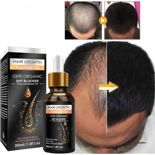 Ginger Hair Growth Essential Oils Promote Hair Regrowth Essence Prevent Baldness Hair Loss Hair Serum Anti-hair Loss Hair Care