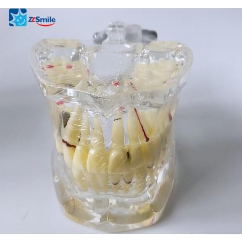 M4001 Adult Model with Pathologies/Dental Tooth Model