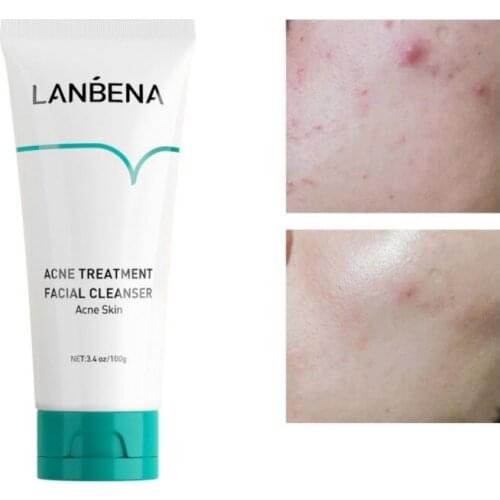 Acne Treatment Washing Cream Face Blackhead Repair Gel Oil Control Shrink Pores Scar Whitening Moisturizer Skin Care Cosmetics