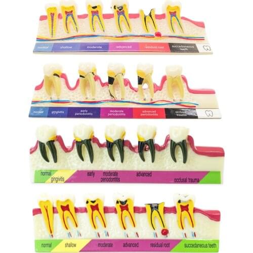 Teeth Periodontal Disease Model Dental Caries breakdown display Periodontitis show Teaching Tooth Model Dentist Communication