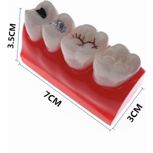 Dental Study Learn Model for Pit and Fissure Sealing Treatment Teeth Model