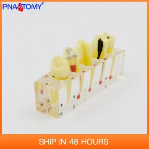 Endodontic pathological model pathology Patient communication treatment Posterior Teeth Dental Pulp Restoration