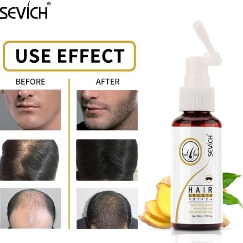 Sevich Hair Growth Essence Spray 50ml for Men Women Hair loss Treatment Serum Ginger Nourish Roots Fast Germinal Hair Care