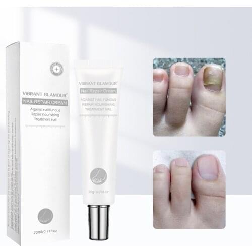 Fungal Nail Treatment Cream Onychomycosis Paronychia Anti-Fungal Nail Infection Herbal Toe Fungus Foot Repair Essence Care 20ml