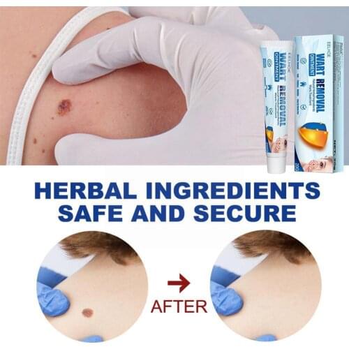 Wart Cream Skin Tag Remover Antibacterial Cream Micro Body Skin Effective Wart Treatment Ointment Extract Ointment Mole Her V4Y1