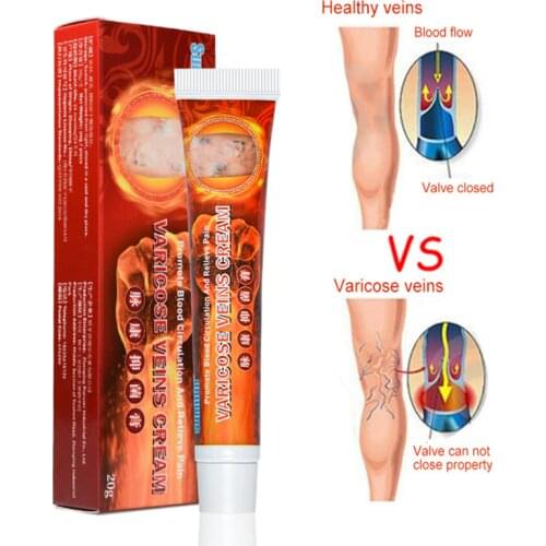 New 20g Varicose Veins Ointmnet Vasculitis Phlebitis Spider Cream Varicosity Angiitis Removal Herbal Medical