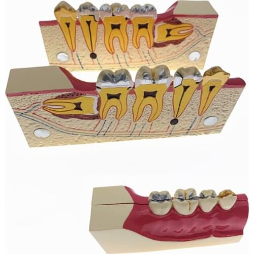 Dental Disease Teeth Anatomy Study Model Molar Cross Section Decomposition model of lower right posterior teeth model