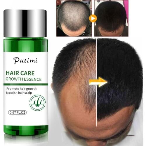 Ginger Hair Growth Dense Hair Fast Hair Growth Serum Oil Hair Loss Treatment Growth Hair For Men Women TSLM1