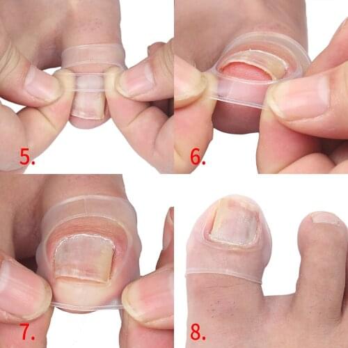 Toe Nail Repair Correction Foot Care Clear Elastic Sleeves Cover Pedicure Treatment - Toe Nail Care - Protects Toe Nail