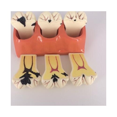 4Xdecayed tooth Decomposition Models Doctor-patient communication model 7 parts free shipping