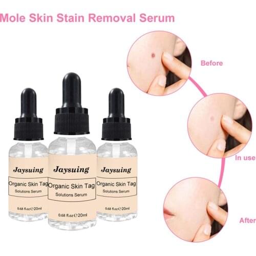 20ml Mole And Skin Tag Remover Liquid Genital Wart Treatment Papillomas Removal Of Warts Skin Tags Removing Against Moles