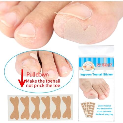 24pcs Toenail Patch Ingrown Toenail Correction Pedicure Tool Toe Inlay Nail Corrector Nail Patch Correction Stickers