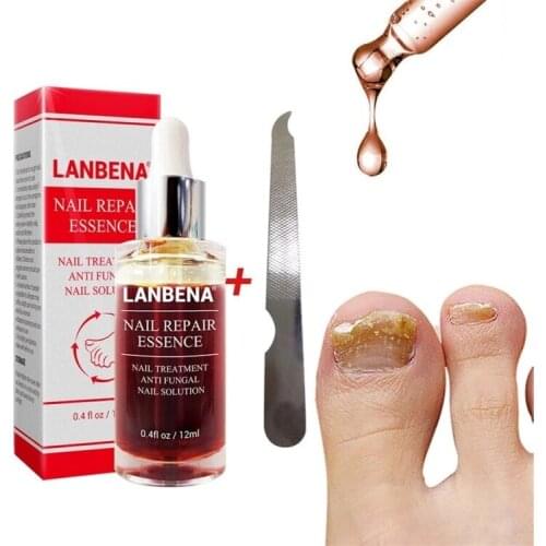 Fungal Nail Treatment Feet Care Essence Nail Foot Whitening Toe Nail Fungus Removal Gel Anti Infection Paronychia Onychomycosis