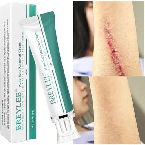 BREYLEE Scar Removal Cream Face Cream Scar Stretchmarks Spots Remover Cream Skin Repair Acne Treatment Whitening Body Cream 30g
