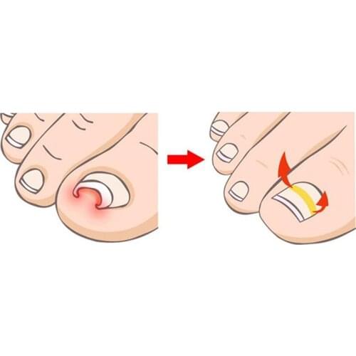 Ingrown Toe Nail Correction Sticker Patch Paronychia Correction File Acronyx Wire Corrector Foot Care Treatment 10pcs/pack