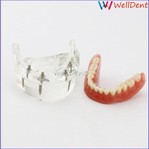 1pc Dental Teeth Model Overdenture Inferior 4 Implant Demo Model Teeth Study Model Tooth Dental Lab
