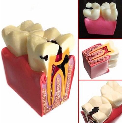 1pcs dental teeth model 6 Times Caries Comparation Study denture Tooth models Dentist Studying and Researching Dentistry product