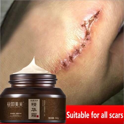 Acne scar removal cream For Old scar Caesarean scars surgical scars burn scars body care Herbs cream kids&Adults 30G