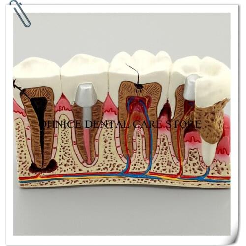 4times Dental Pathologies teeth Model M4029 shows root canal treatment Caries study tooth Model for dentist