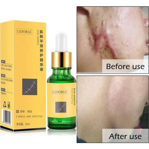 Removing Dark Spots Cream Freckle Speckle Fade Repair Skin Care Whitening Anti Winkles Face Essence Scar Removal Beauty